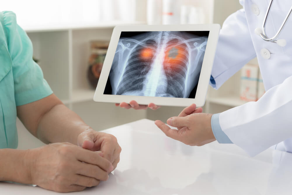 „Test noktima“ otkriva da li vam preti rak pluća