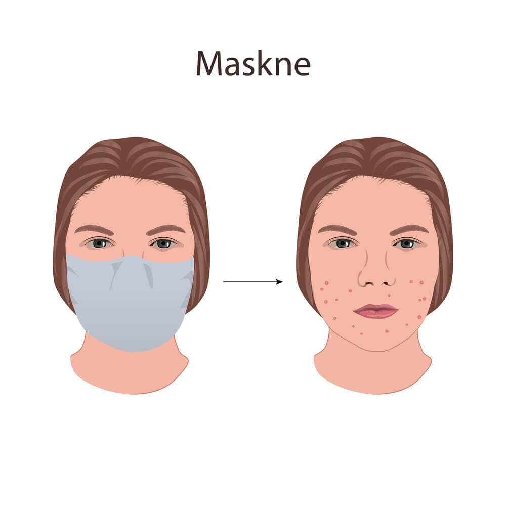 Maskne su nove akne, a evo kako da ih se rešite!