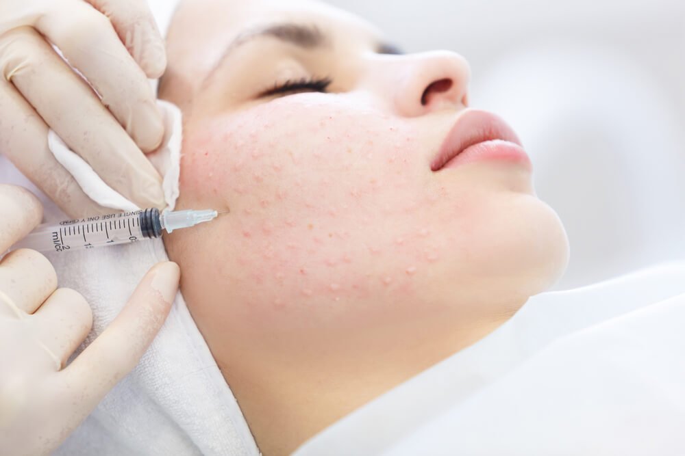 Mezoterapija – vodič kroz proceduru koja će učiniti vašu kožu besprekornom