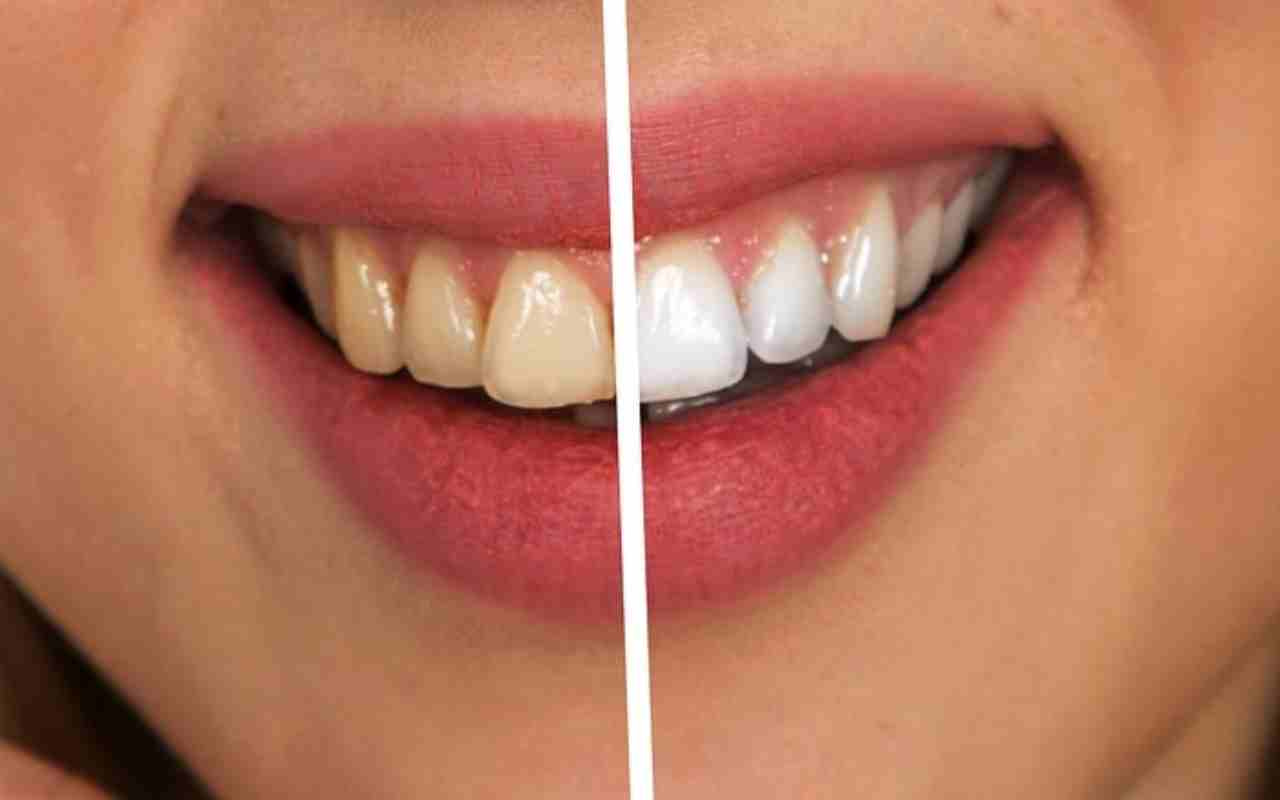 Beljenje zuba – sve što je potrebno da znate